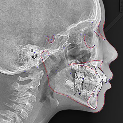 CHỤP CEPHALOMETRIC